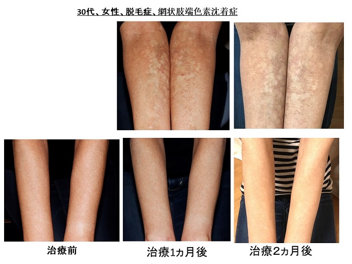 円形脱毛症　病院